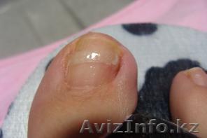 решение броблемы вросших ногтей - Изображение #1, Объявление #319911