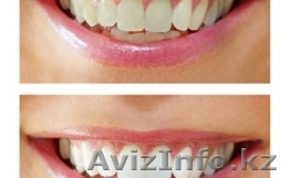 ПРОФЕССИОНАЛЬНОЕ ОТБЕЛИВАНИЕ В АЛМАТЫ - Изображение #1, Объявление #998097