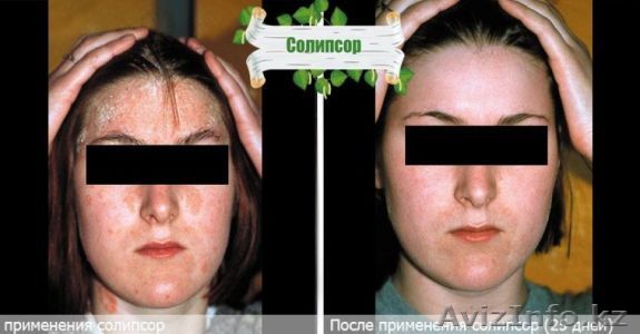 Впервые крем от псориаза "Солипсор" без запаха! - Изображение #1, Объявление #1106142