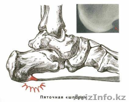 лечения пяточной шпоры   - Изображение #1, Объявление #1317399