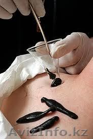 Лечение пиявками ИБС в Алматы - Изображение #1, Объявление #1587637