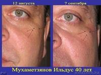 КРЕМ ОТ МОРЩИН НА ОСНОВЕ ГИАЛУРОНОВОЙ КИСЛОТЫ.ГЕЛЬ МИЛЛЕНИУМ ОТ ВИЗИОН. - Изображение #5, Объявление #335778