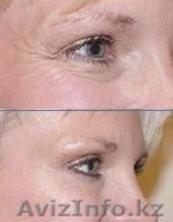 КРЕМ ОТ МОРЩИН НА ОСНОВЕ ГИАЛУРОНОВОЙ КИСЛОТЫ.ГЕЛЬ МИЛЛЕНИУМ ОТ ВИЗИОН. - Изображение #4, Объявление #335778