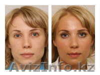 Плазмолифтинг -омоложение на 15-20 лет - Изображение #2, Объявление #366425