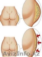 Худеем за 2 недели, антицеллюлитный, вакуумный и лечебный массаж - Изображение #2, Объявление #919047