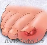 Коррекция вросших ногтей. - Изображение #4, Объявление #1325161