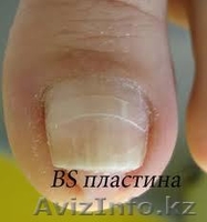 Коррекция вросших ногтей. - Изображение #2, Объявление #1325161