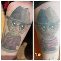 Лазерное удаление татуировок в Алматы - Изображение #2, Объявление #1523170