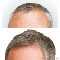 ПЕРЕСАДКА БИОИДЕНТИЧНЫХ ВОЛОС в Казахстане - Изображение #2, Объявление #1550943