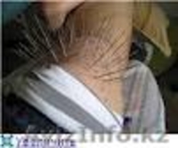 Иглотерапия в Алматы - Изображение #2, Объявление #1587800