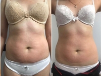 ИЗБАВЬСЯ ОТ ЦЕЛЛЮЛИТА И ЖИРОВЫХ ОТЛОЖЕНИЙ БЕЗОПАСНО И ЭФФЕКТИВНО! - Изображение #6, Объявление #1665699