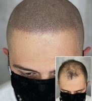 Трихопигментация головы в Алматы - Изображение #1, Объявление #1720226