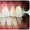 Отбеливание зубов #1057624