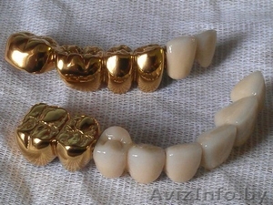 Установки  покрытия зубных протезов  "под золото"  из Беларуси - Изображение #7, Объявление #850572