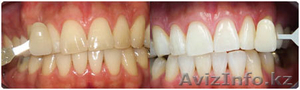 Отбеливание зубов - Изображение #1, Объявление #1057624