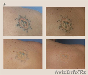 Лазерное удаление татуировок - Изображение #1, Объявление #1088717