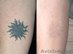 Лазерное удаление не качественных тату и татуажа - Изображение #3, Объявление #1263797