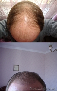 Пересадка волос методом FUE. Трансплантация волос в Турции. Восстановление волос - Изображение #1, Объявление #1328379