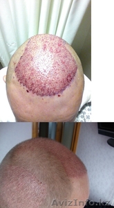 Пересадка волос методом FUE. Трансплантация волос в Турции. Восстановление волос - Изображение #4, Объявление #1328379
