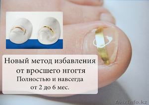 Как избавиться от вросшего ногтя в Алматы?  - Изображение #3, Объявление #1320557