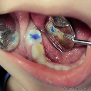 Лечение молочных зубов в стоматологии Классик-Ар - Изображение #1, Объявление #1026726