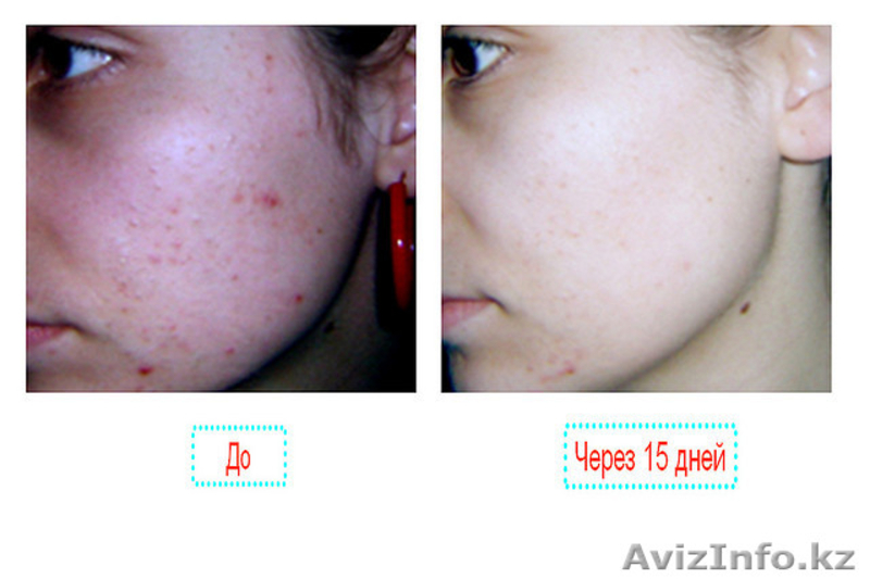 Гель Миллениум.ЭФФЕКТИВНОЕ СРЕДСТВО ОТ ПРЫЩЕЙ. - Изображение #7, Объявление #270937