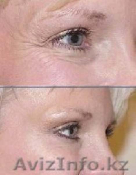 КРЕМ ОТ МОРЩИН НА ОСНОВЕ ГИАЛУРОНОВОЙ КИСЛОТЫ.ГЕЛЬ МИЛЛЕНИУМ ОТ ВИЗИОН. - Изображение #4, Объявление #335778