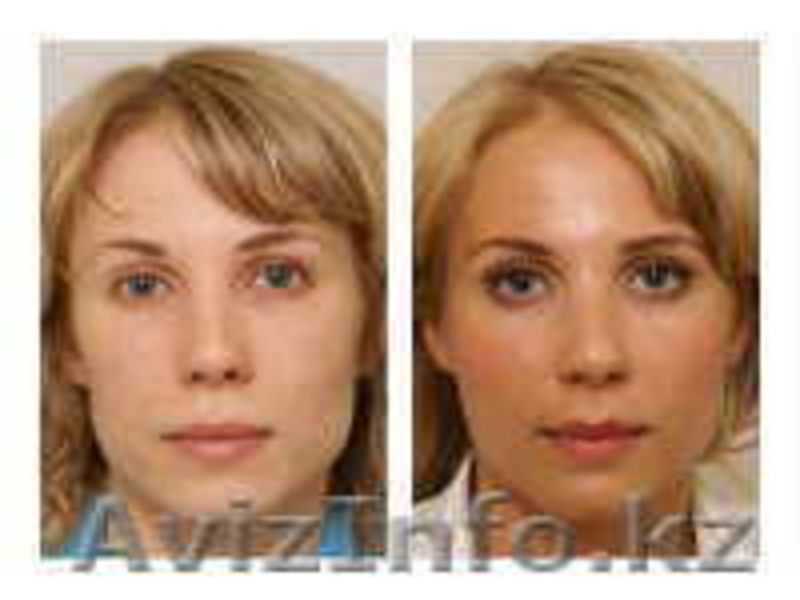 Плазмолифтинг -омоложение на 15-20 лет - Изображение #2, Объявление #366425
