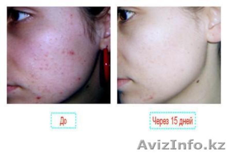 ГЕЛЬ МИЛЛЕНИУМ.КРЕМ С ГИАЛУРОНОВОЙ КИСЛОТОЙ.КРЕМ ОТ УГРЕЙ,МОРЩИН,ШРАМЫ - Изображение #6, Объявление #608003