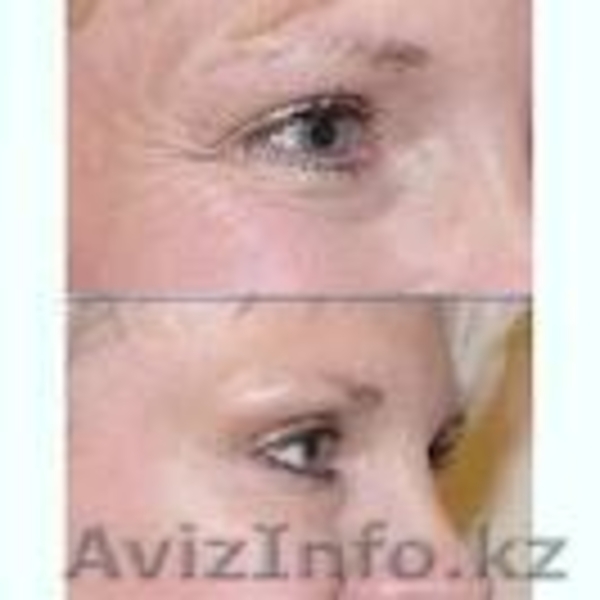 ГЕЛЬ МИЛЛЕНИУМ.КРЕМ С ГИАЛУРОНОВОЙ КИСЛОТОЙ.КРЕМ ОТ УГРЕЙ,МОРЩИН,ШРАМЫ - Изображение #4, Объявление #608003