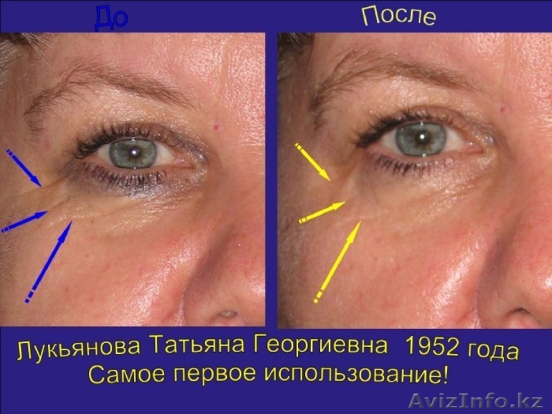 ГЕЛЬ МИЛЛЕНИУМ.КРЕМ С ГИАЛУРОНОВОЙ КИСЛОТОЙ.КРЕМ ОТ УГРЕЙ,МОРЩИН,ШРАМЫ - Изображение #5, Объявление #608003