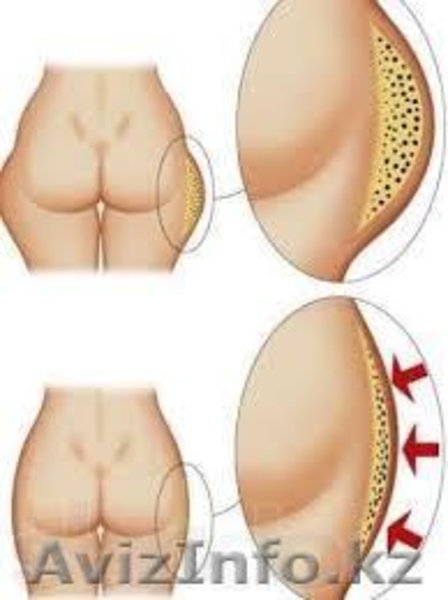 Худеем за 2 недели, антицеллюлитный, вакуумный и лечебный массаж - Изображение #2, Объявление #919047