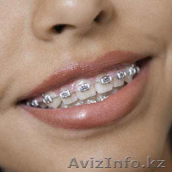 Брекеты Исправление прикуса Классик Ар  - Изображение #1, Объявление #1161357