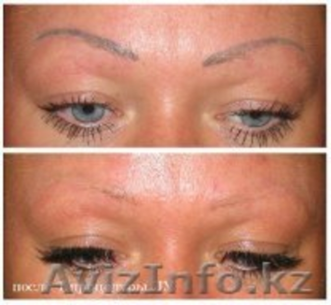 Лазерное удаление не качественных тату и татуажа - Изображение #4, Объявление #1263797