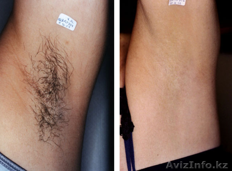 Фотоэпиляция(удаление лишних волос на долгие годы),пилинги,мезотерапия - Изображение #3, Объявление #1282048