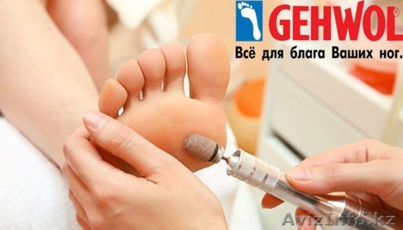 Коррекция вросших ногтей. - Изображение #3, Объявление #1325161