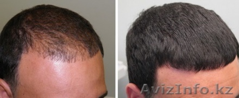 Alixir лосьон от облысения и выпадения волос - Изображение #3, Объявление #1482985