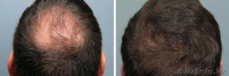 Трихопигментация в Казахстане  - Изображение #6, Объявление #1481932