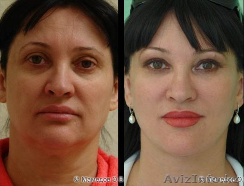 Врач-косметолог с высшим медицинским образованием-Махмудова Д. Тел: 87017831918  - Изображение #10, Объявление #1487808