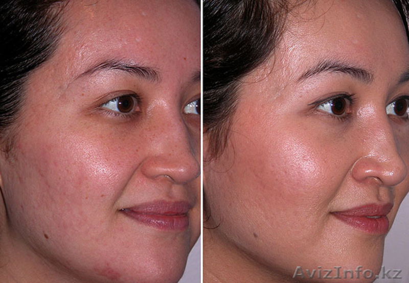 Врач-косметолог с высшим медицинским образованием-Махмудова Д. Тел: 87017831918  - Изображение #3, Объявление #1487808