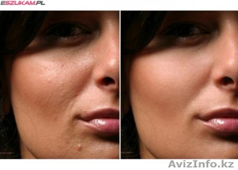 Врач-косметолог с высшим медицинским образованием-Махмудова Д. Тел: 87017831918  - Изображение #8, Объявление #1487808