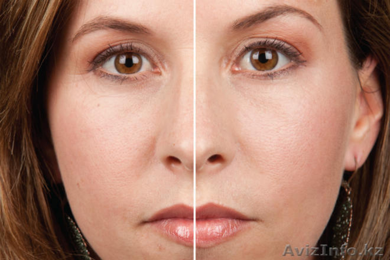 Врач-косметолог с высшим медицинским образованием-Махмудова Д. Тел: 87017831918  - Изображение #6, Объявление #1487808