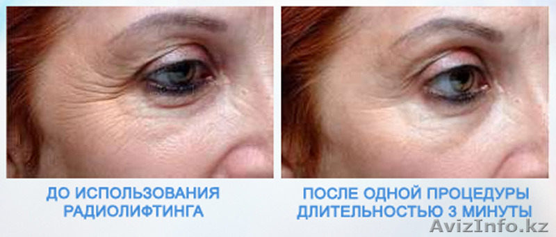 Врач-косметолог с высшим медицинским образованием-Махмудова Д. Тел: 87017831918  - Изображение #7, Объявление #1487808