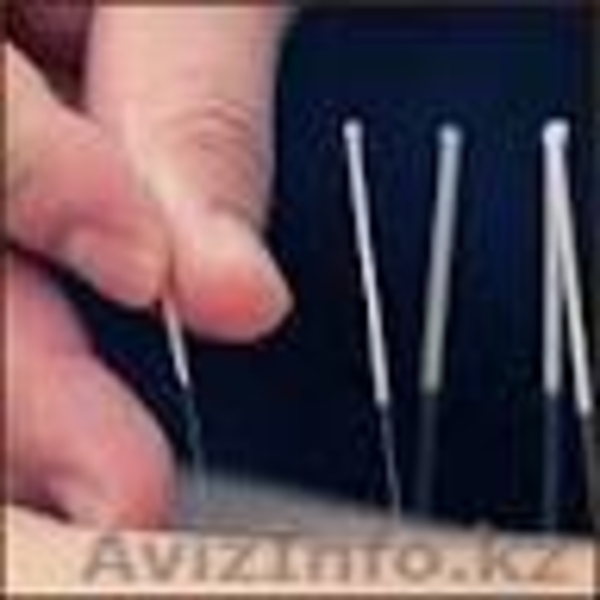 Иглотерапия в Алматы - Изображение #1, Объявление #1587800