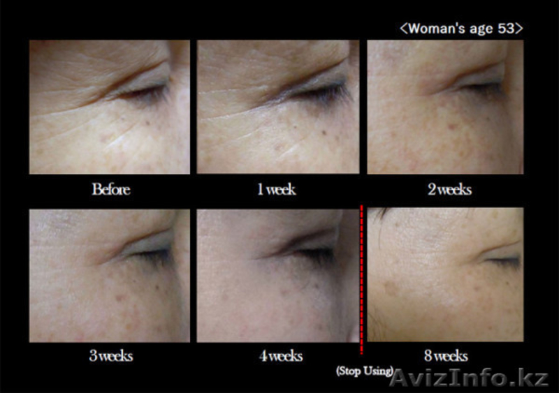Супер акция! Патчи для глаз  из гиалуроновой кислотой с микроиглами - Изображение #3, Объявление #1608200