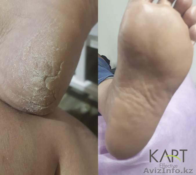 Подологический Центр КАРТ EFFECTIVE - Изображение #3, Объявление #1644128