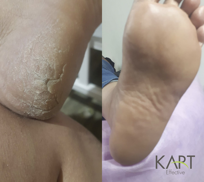 Подологический центр Карт в Алматы - Изображение #3, Объявление #1650762