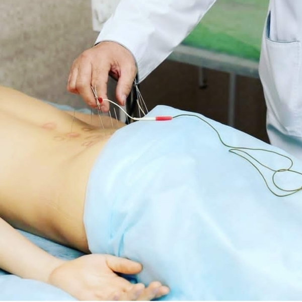 Иглорефлексотерапия в Алматы - Изображение #4, Объявление #1663653