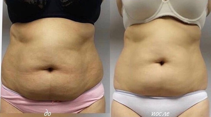 ИЗБАВЬСЯ ОТ ЦЕЛЛЮЛИТА И ЖИРОВЫХ ОТЛОЖЕНИЙ БЕЗОПАСНО И ЭФФЕКТИВНО! - Изображение #3, Объявление #1665699