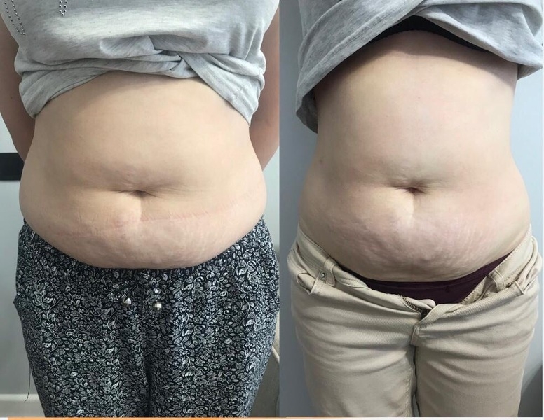 ИЗБАВЬСЯ ОТ ЦЕЛЛЮЛИТА И ЖИРОВЫХ ОТЛОЖЕНИЙ БЕЗОПАСНО И ЭФФЕКТИВНО! - Изображение #5, Объявление #1665699